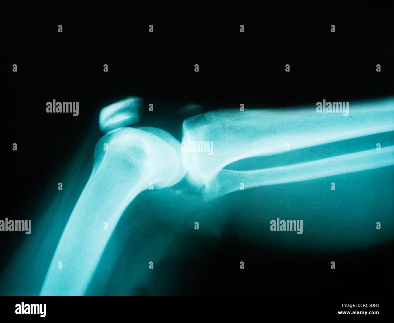 X-ray of human arm showing broken bone Stock Photo