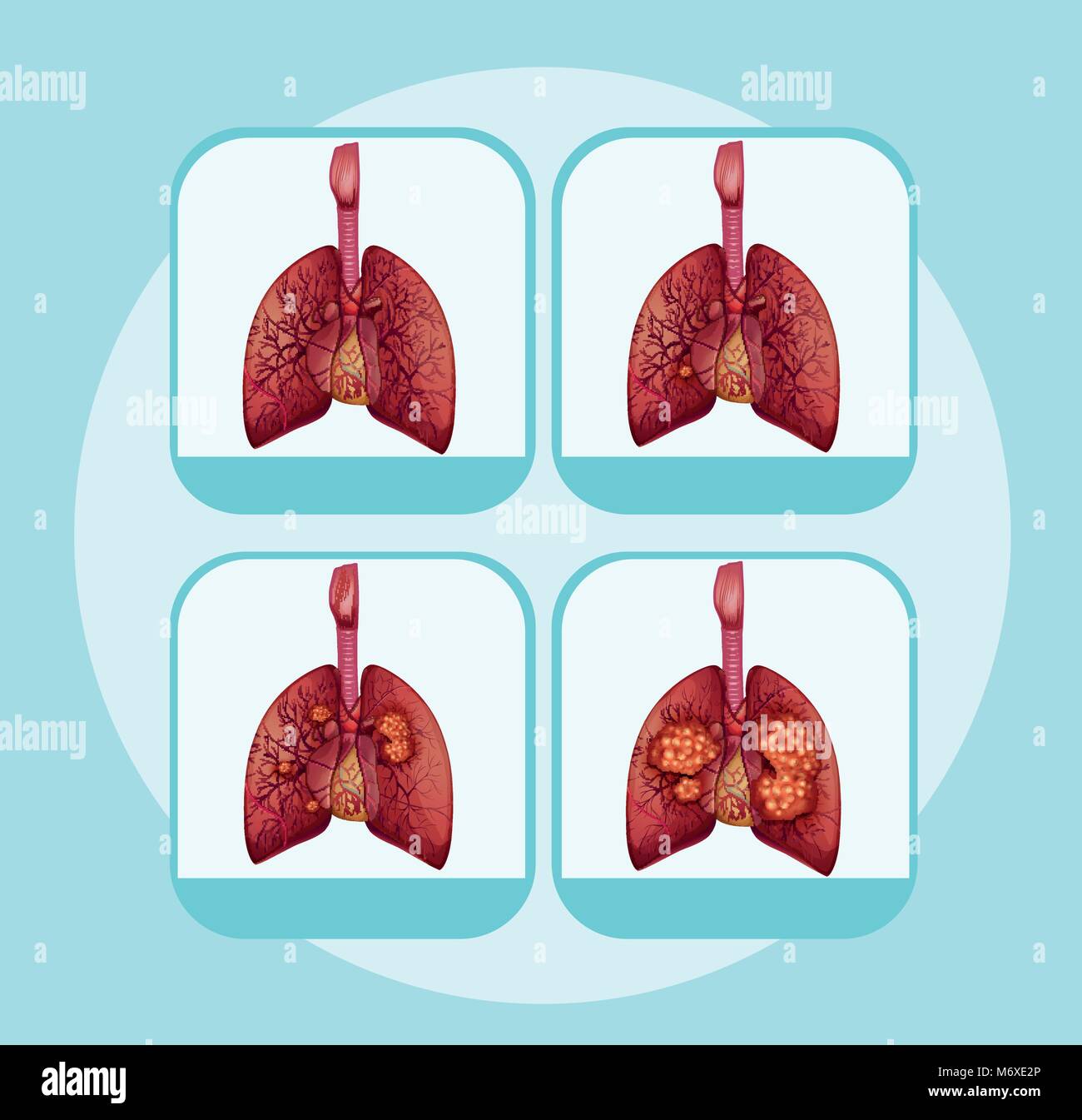 Lung Cancer Diagram For Kids