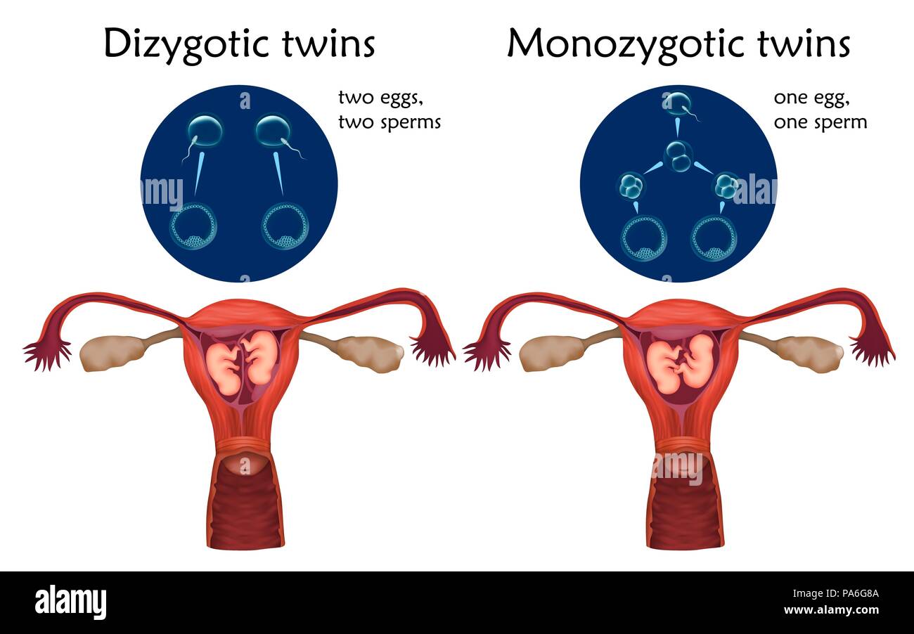 Triplet Pregnancy Diagram