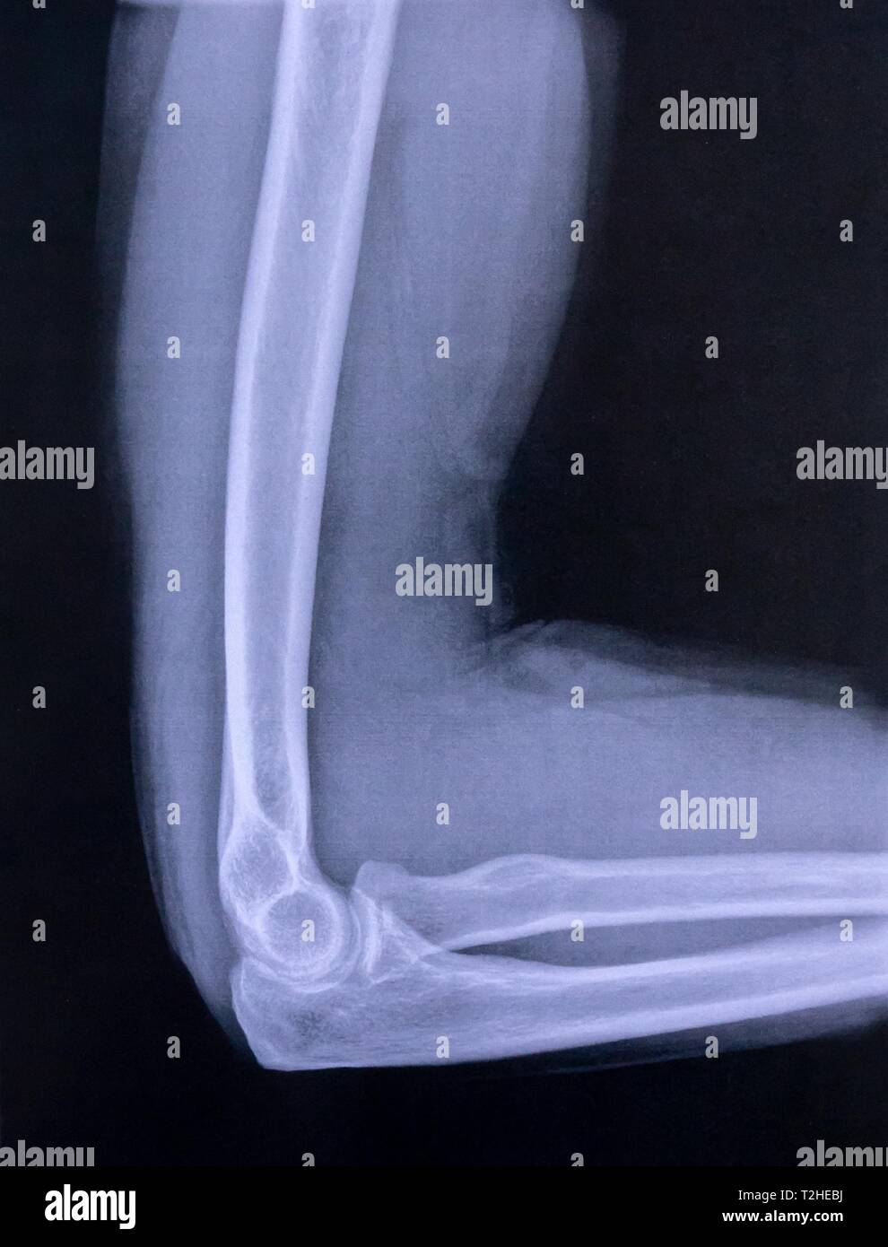 X-ray image of elbow and upper arm, Germany Stock Photo