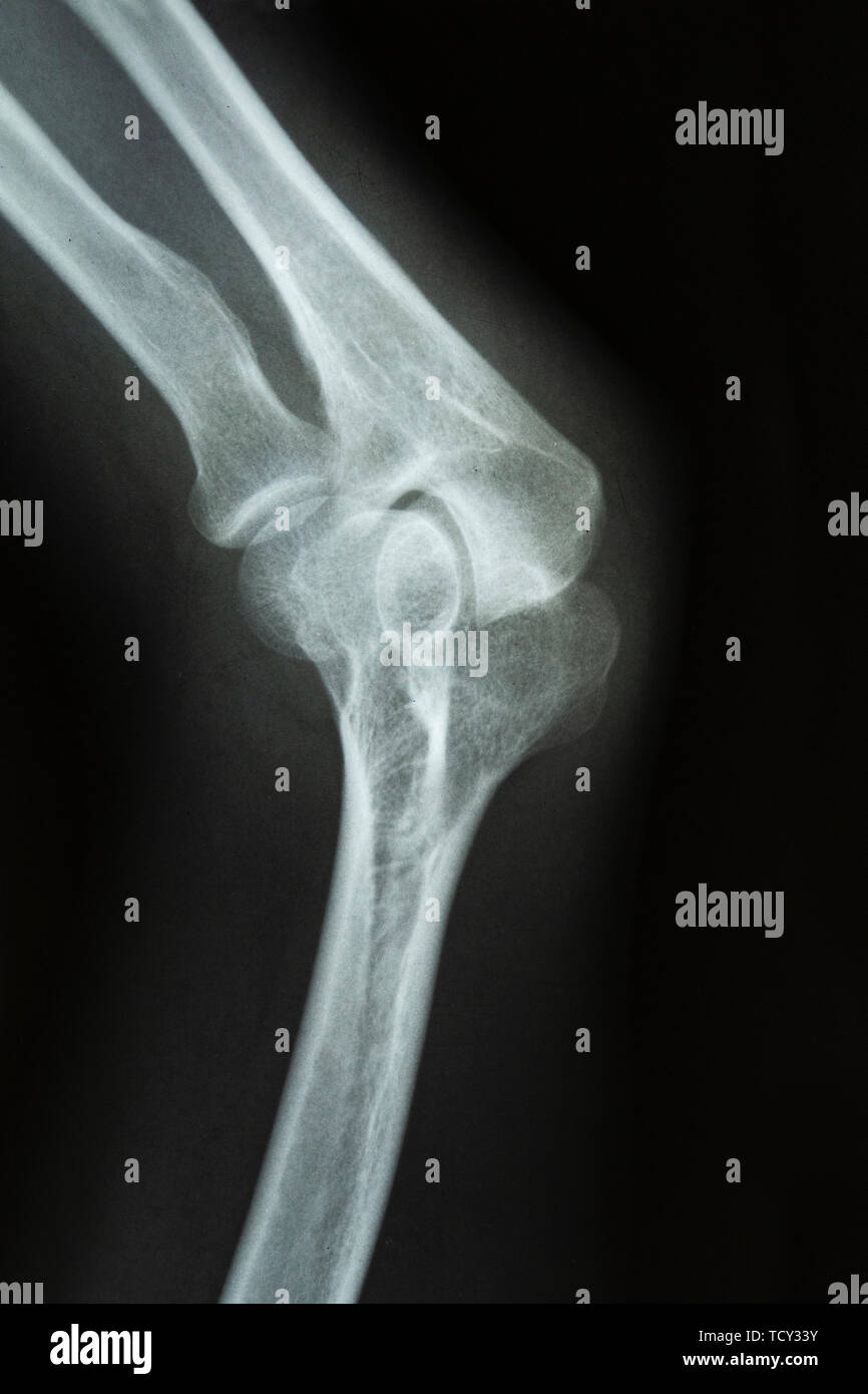 X-ray of an elbow joint Stock Photo