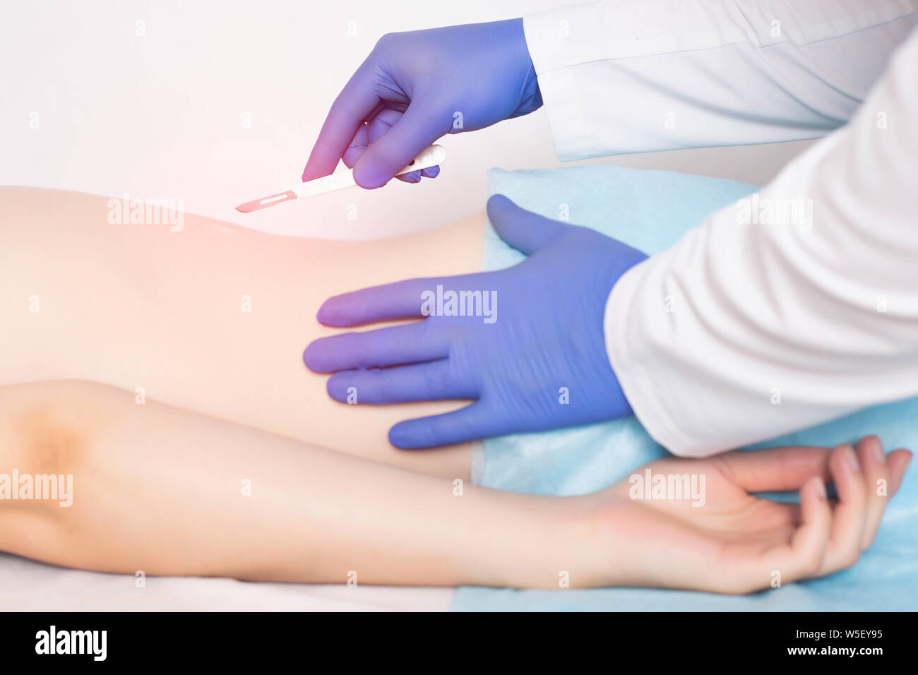 Doctor holding a surgical scalpel near the spine of the girl concept of spinal surgery diskectomy and laminectomy, spondylolisthesis Stock Photo