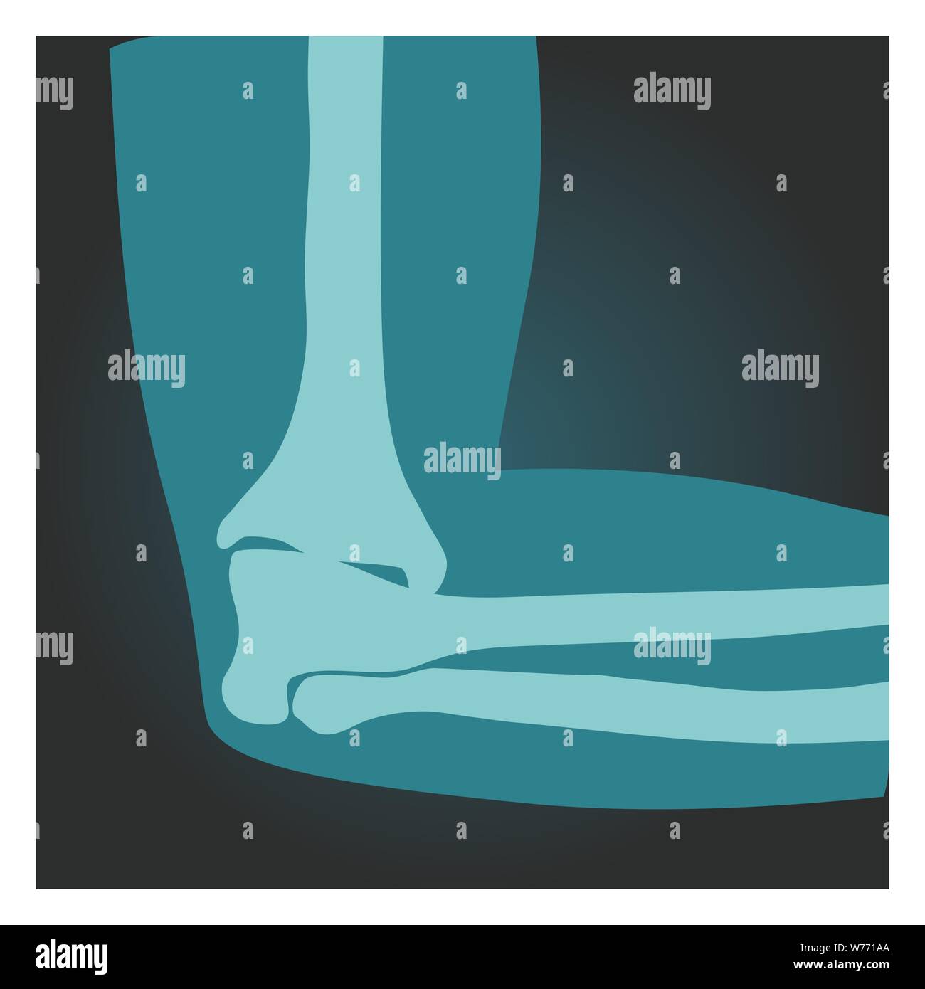 X-ray shot of elbow side view, human body, bones of hand, radiography, vector illustration. Stock Vector