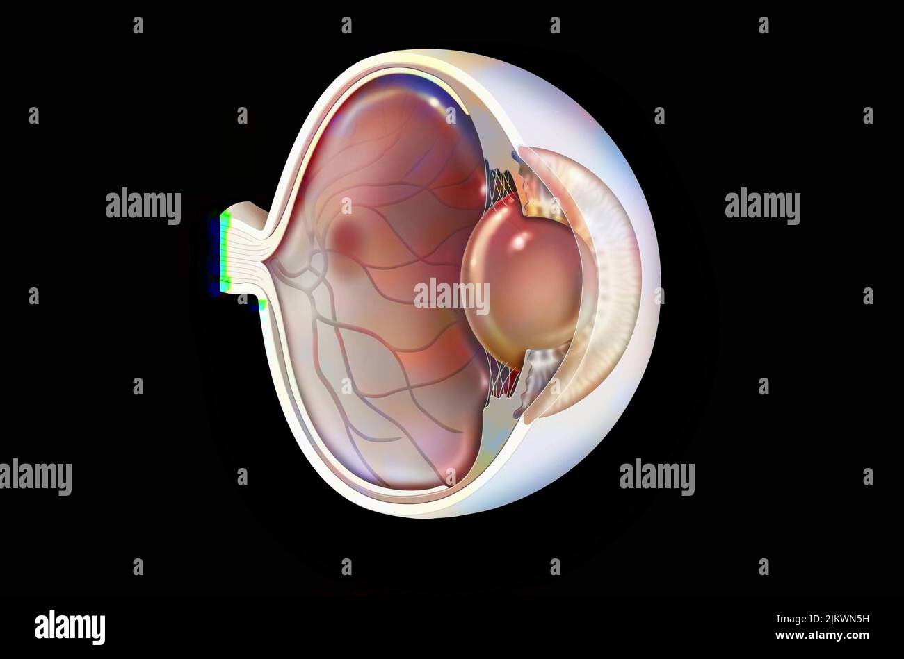 Auge: Altersbedingte Makuladegeneration (degenerative Erkrankung der Makula). Stockfoto