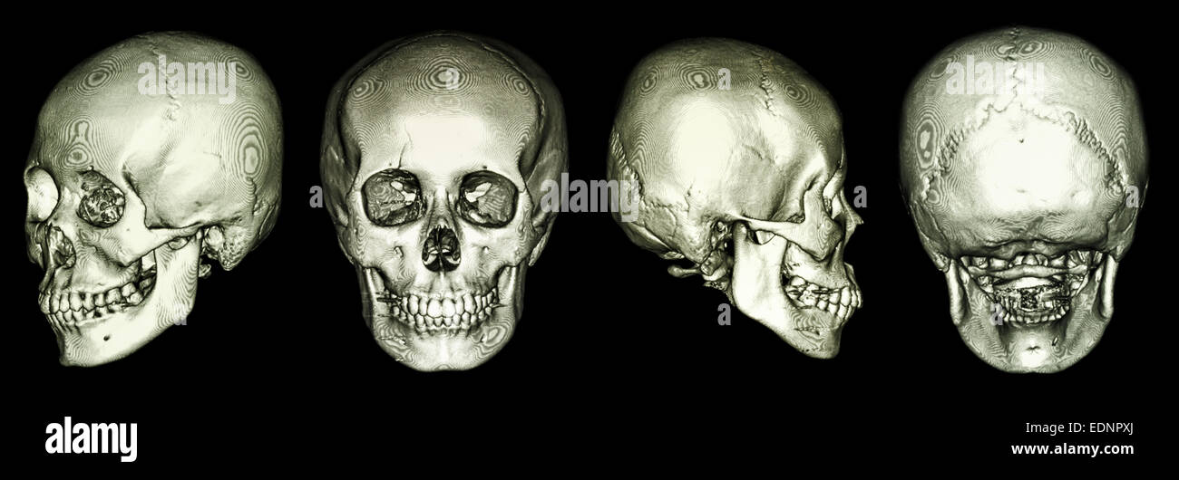 CT-Scan des menschlichen Schädels und 3D Stockfoto