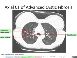 Cystic Fibrosis: Axial CT | Calgary Guide