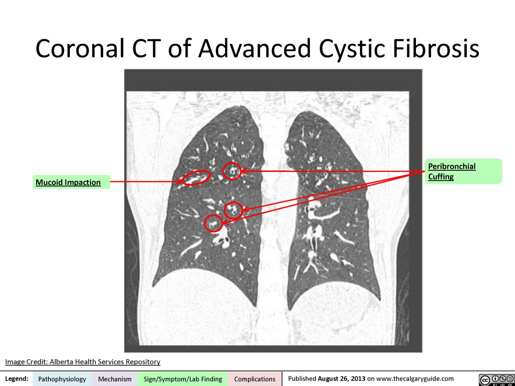 Cystic Fibrosis: Coronal CT | Calgary Guide