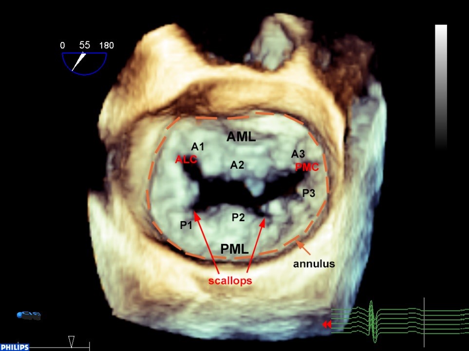 optimizmus rozptyl kaliber mitral valve 3d echo operácie kúzlo nahlas