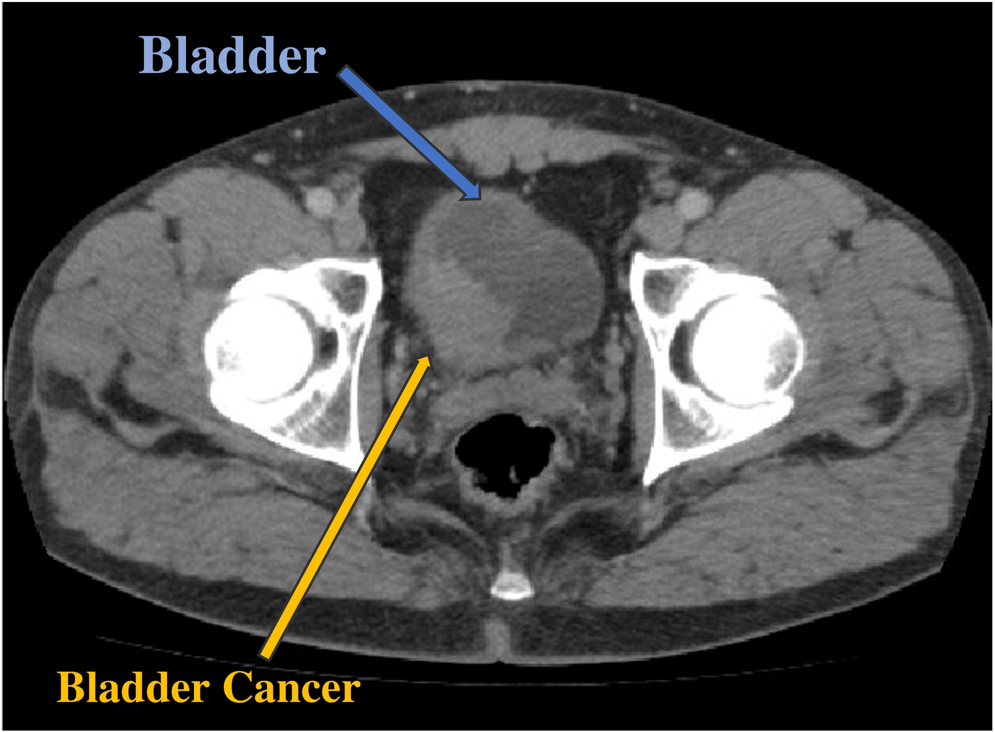 will bladder cancer show up on an ultrasound Updated