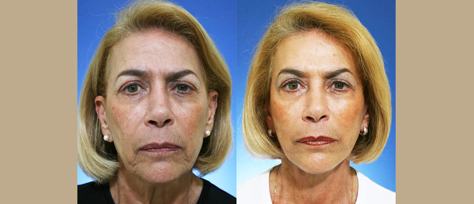 boca raton facelift