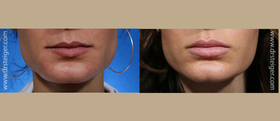 lip enhancement