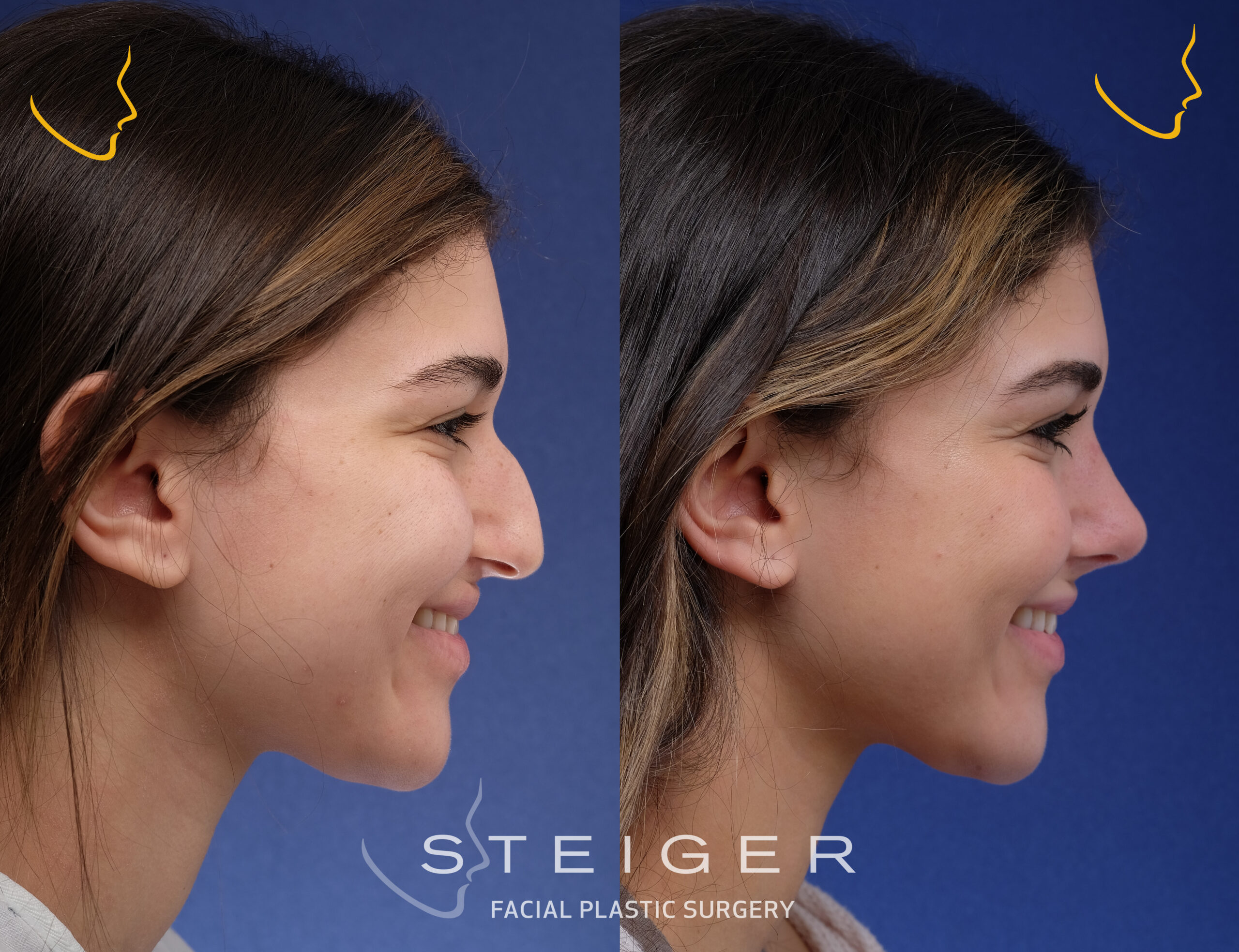 rhinoplasty-before-and-after-droopy-tip