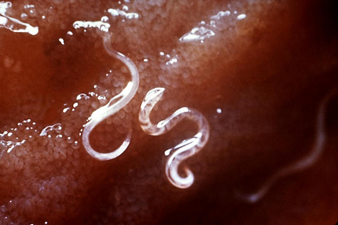 Worms In Humans Pictures In Stool