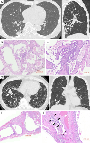 Honeycomb lung is a major risk factor for preoperative radiological ...