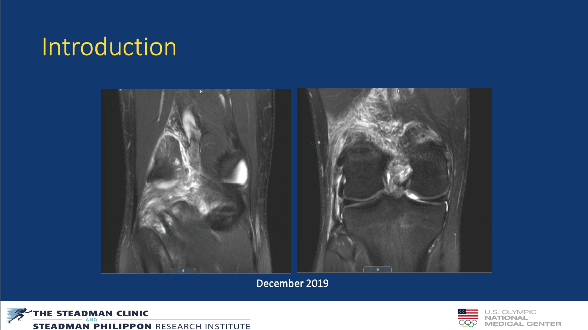 Fibular-Based Technique for Posterolateral Corner Reconstructions