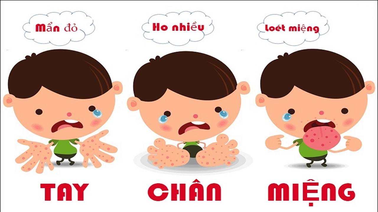 Khái Niệm Bệnh Tay Chân Miệng: Nguyên Nhân, Triệu Chứng, Cách Phòng Ngừa