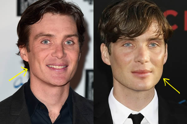 Cillian Murphy botox before and after photo comparison