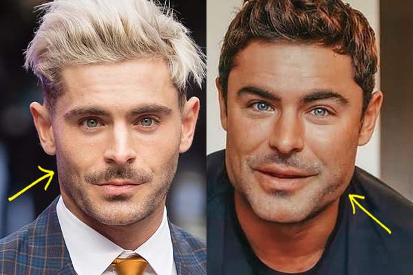 Zac Efron botox before and after comparison photo