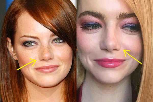 Emma Stone nose job before and after comparison photo