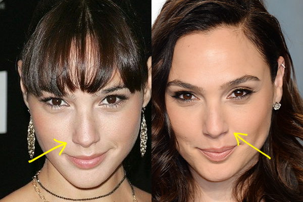 Gal Gadot nose job before and after comparison photo