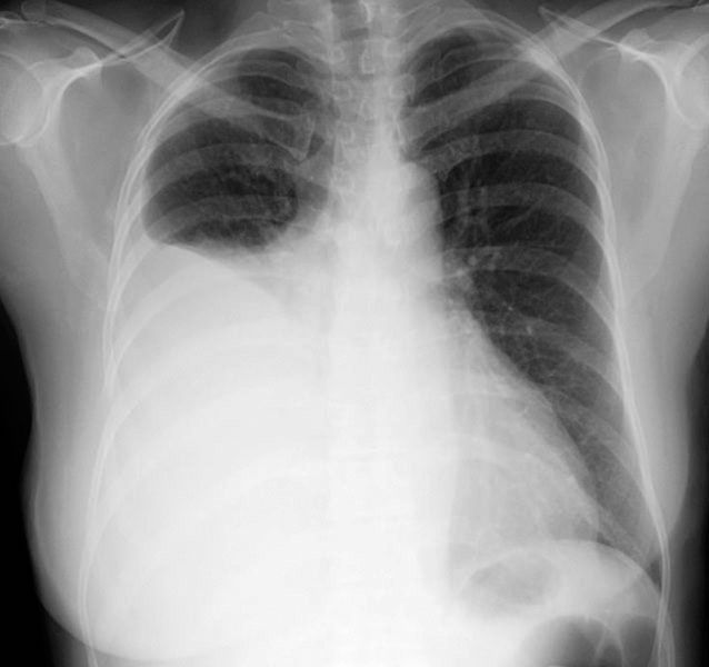 Chest X Ray Pleural Effusion Interpretation