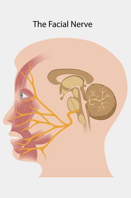 The damaged facial nerve