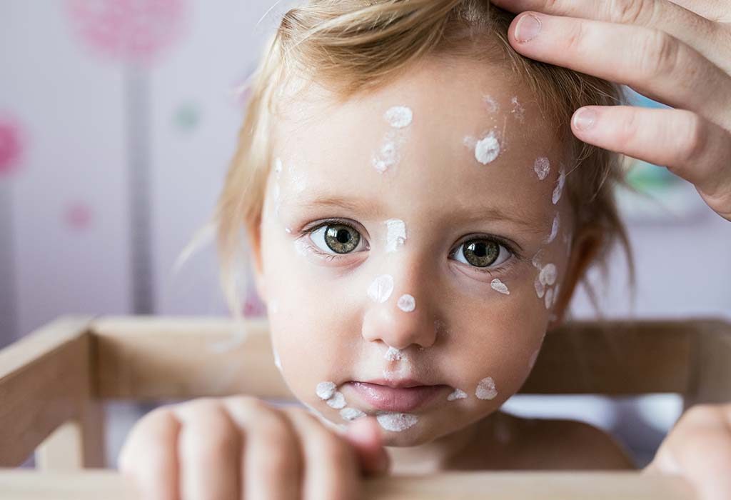 Baby chickenpox