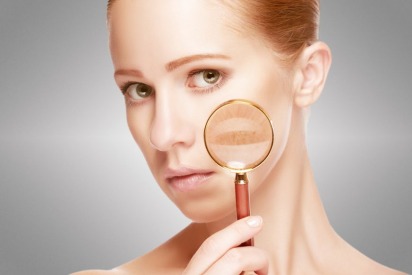 Freckles and Melasma Treatment in Dubai