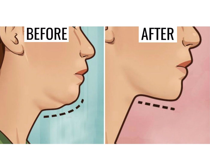 Can-double-chin-can-be-removed-through-exercises