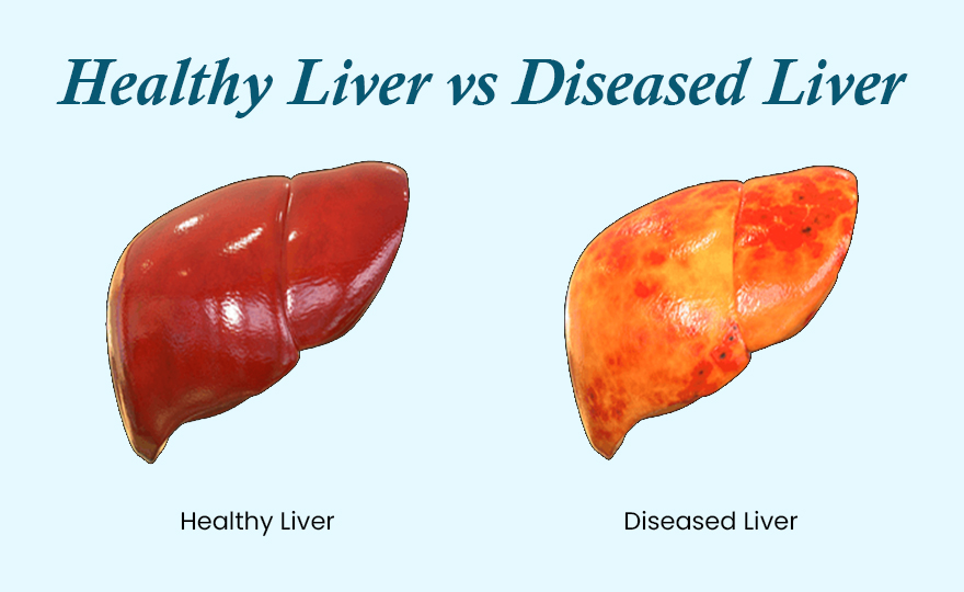 Simple Yoga Asanas for Fatty Liver - Improve Your Liver Health