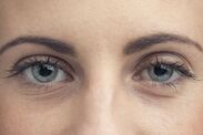 dark circles low iron levels