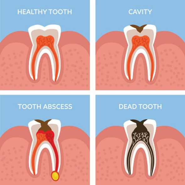 Dental Infection Symptoms