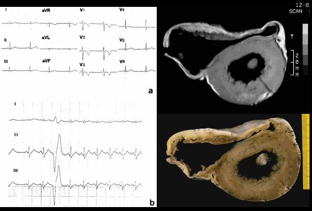 Arrhythmogenic Right Ventricular Dysplasia