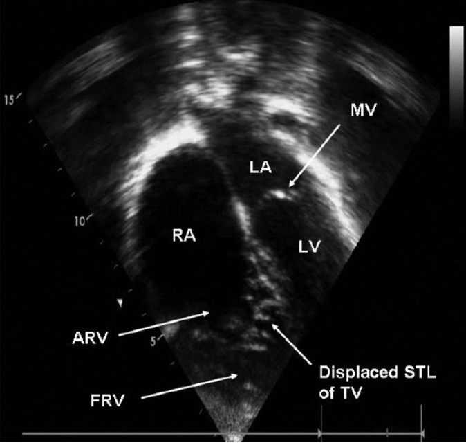 Ebstein's Anomaly | Concise Medical Knowledge