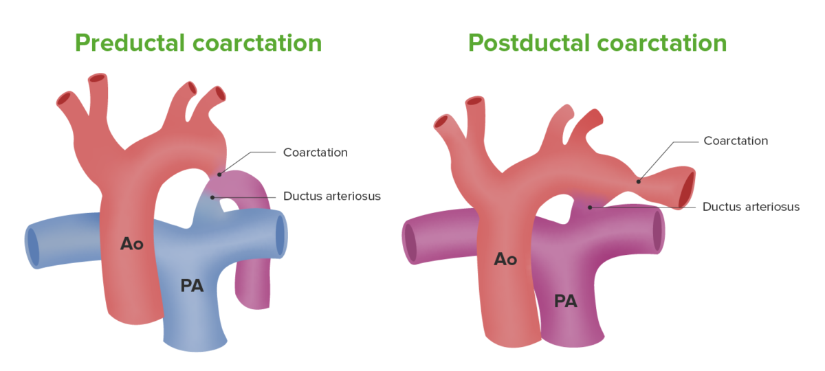 Illustration coarctation of aorta