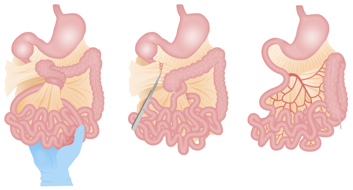 Ladd’s procedure