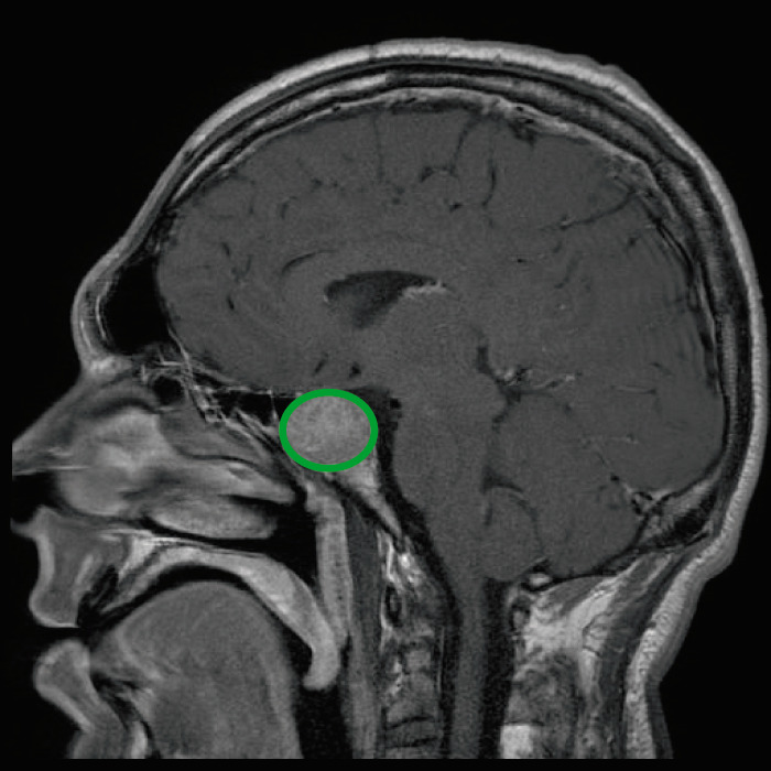 Pituitary Mri Labeled