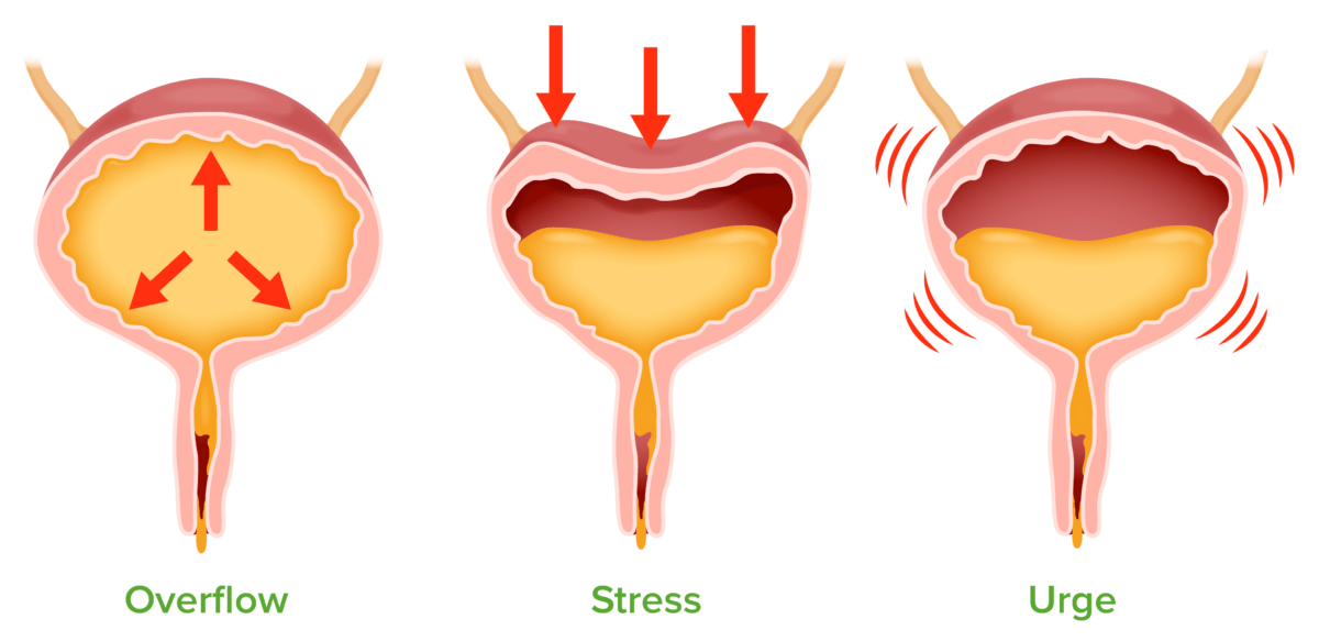 Urinary incontinence