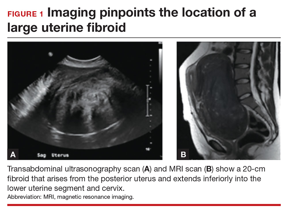 Ultrasound Imaging Fibroid Complicating A Possible