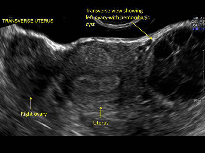 Hemorrhagic Ovarian Cysts One Entity With Many Appearances Mdedge Obgyn