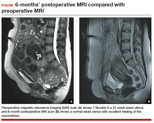 Myomectomy - Pictures