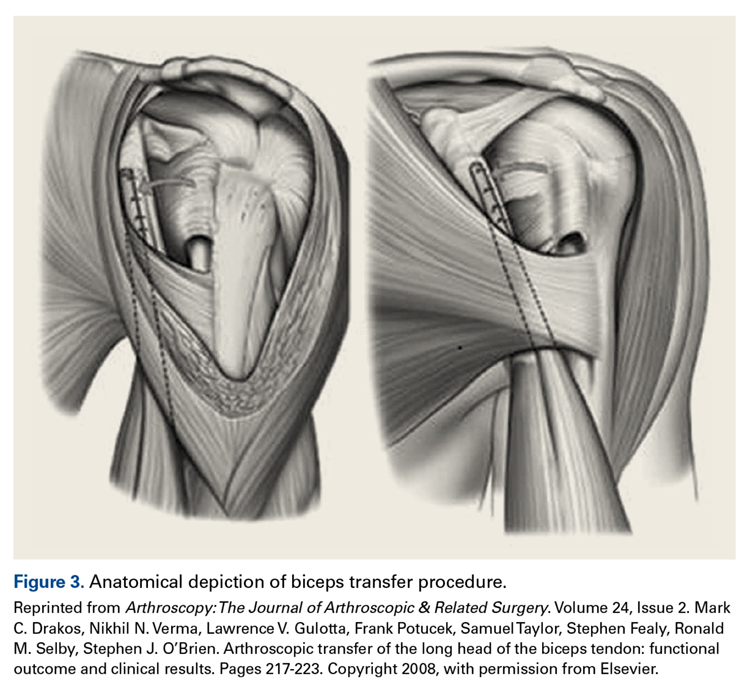 Conjoint Tendon Shoulder