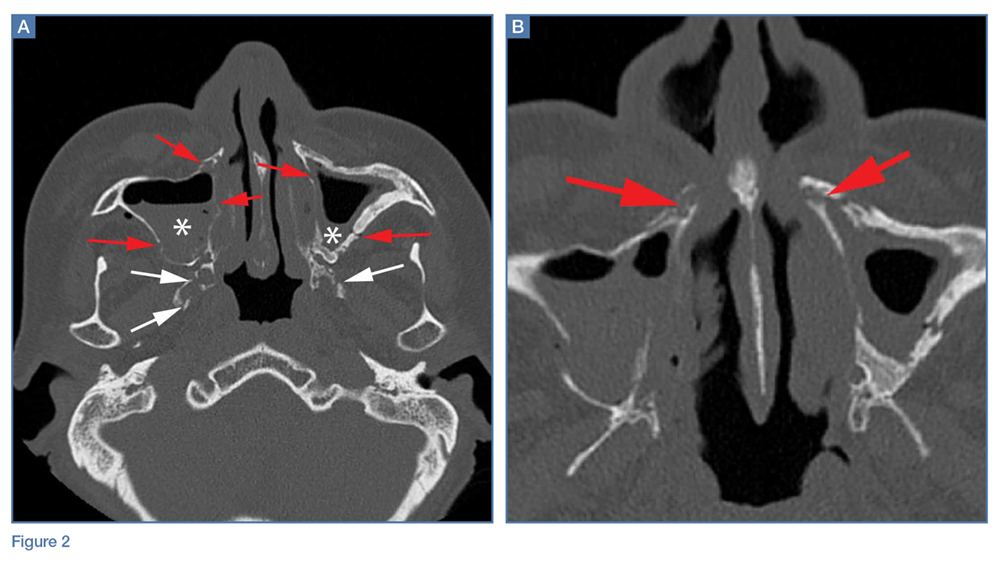 Maxilla Fracture