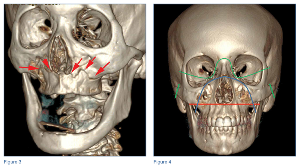 Maxillary Fracture