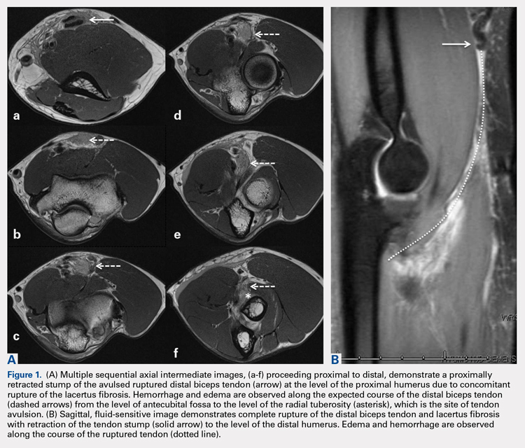 Distal Bicep Tendon Mri