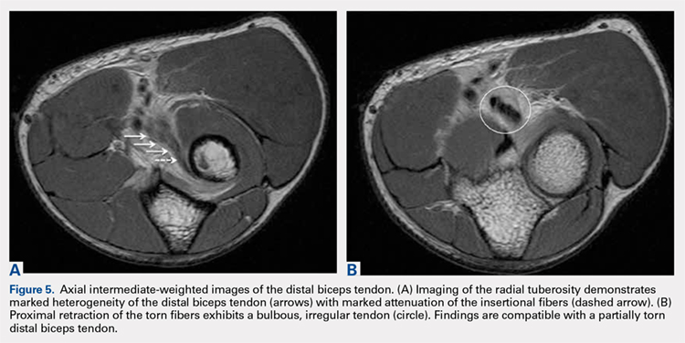 Distal Bicep Tendon Mri