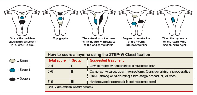 Hysteroscopic Myomectomy