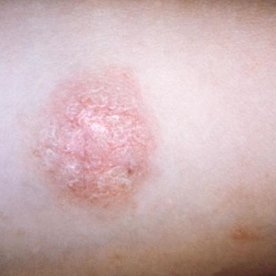 Precise cause of pityriasis rosea remains elusive | MDedge Pediatrics