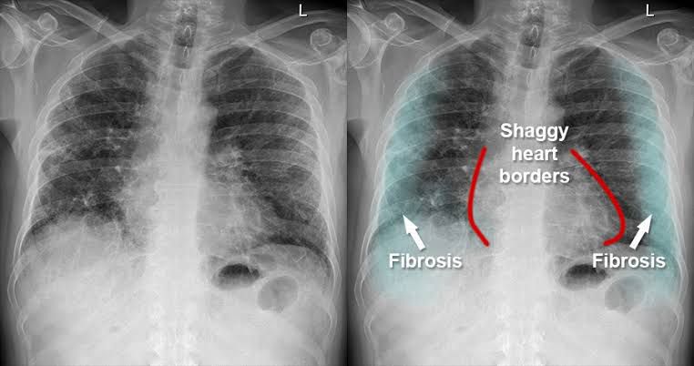 Pulmonary fibrosis - MEDizzy