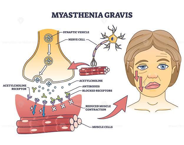 Myasthenia Gravis - MEDizzy